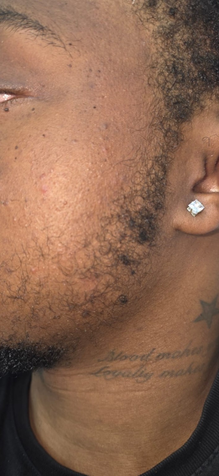 Facial hair restoration detail image
