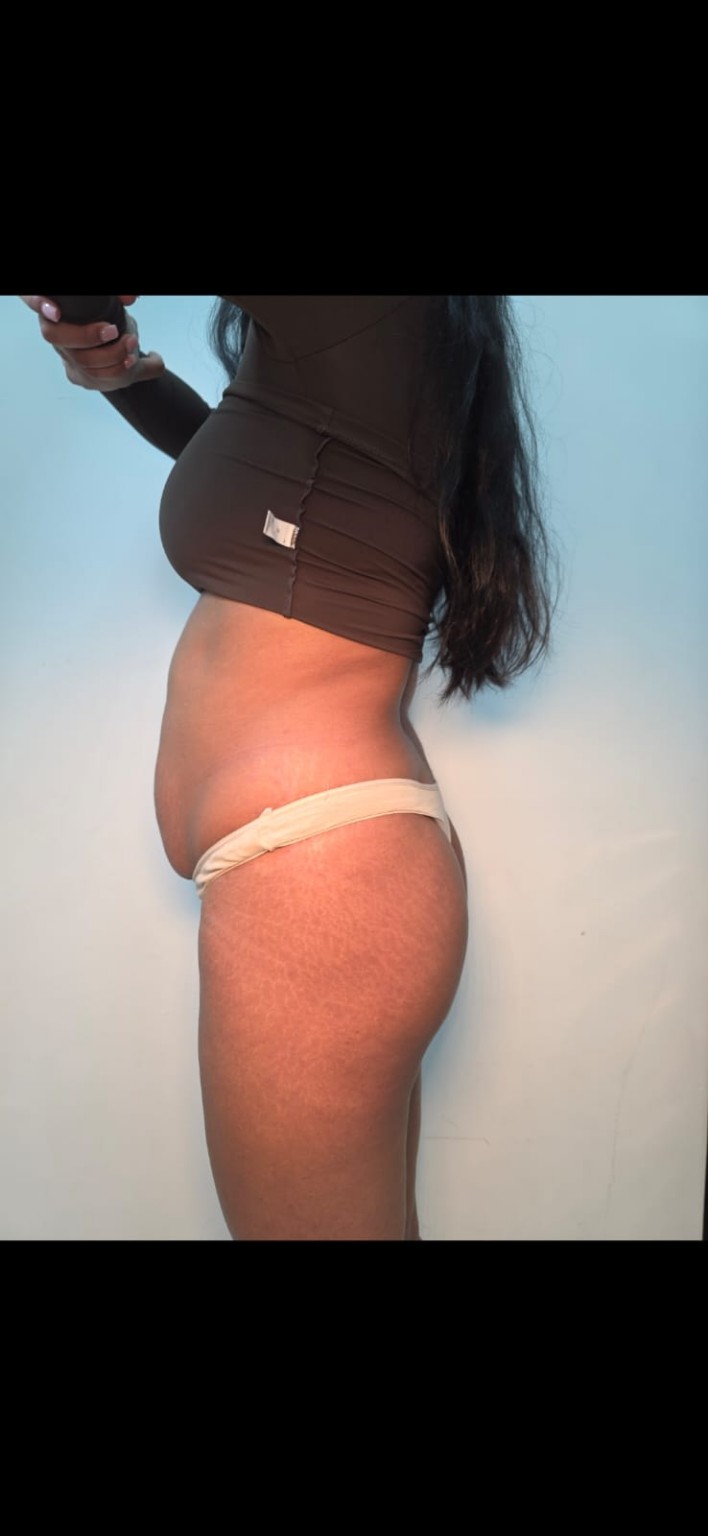 Body contouring side profile treatment image