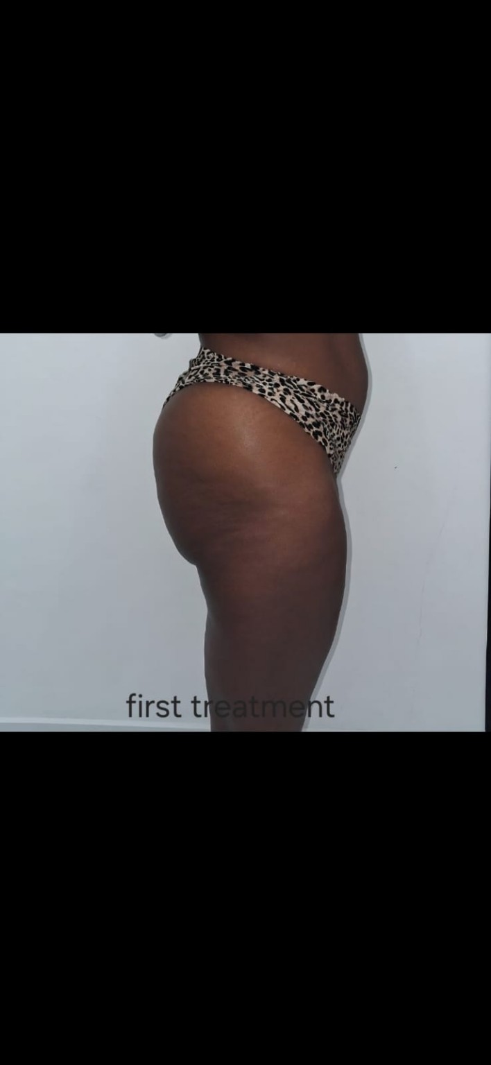 Body contouring first treatment side profile image