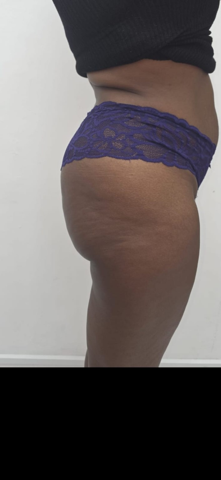 Body contouring side profile results image