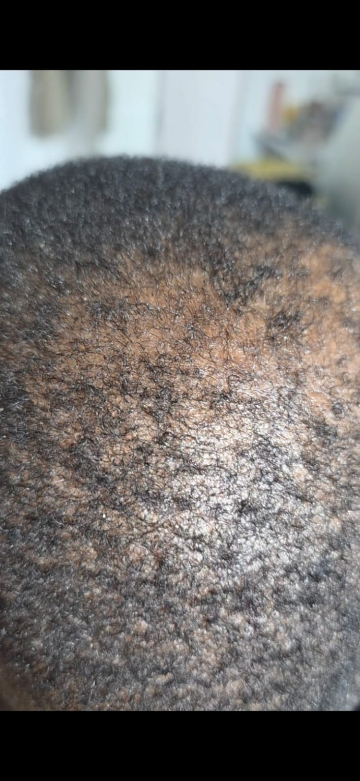 Hair restoration scalp close-up image