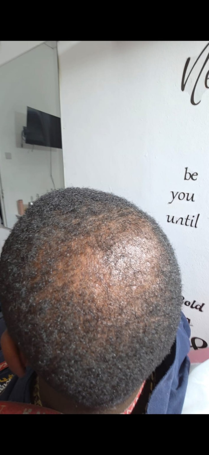 Hair restoration crown image