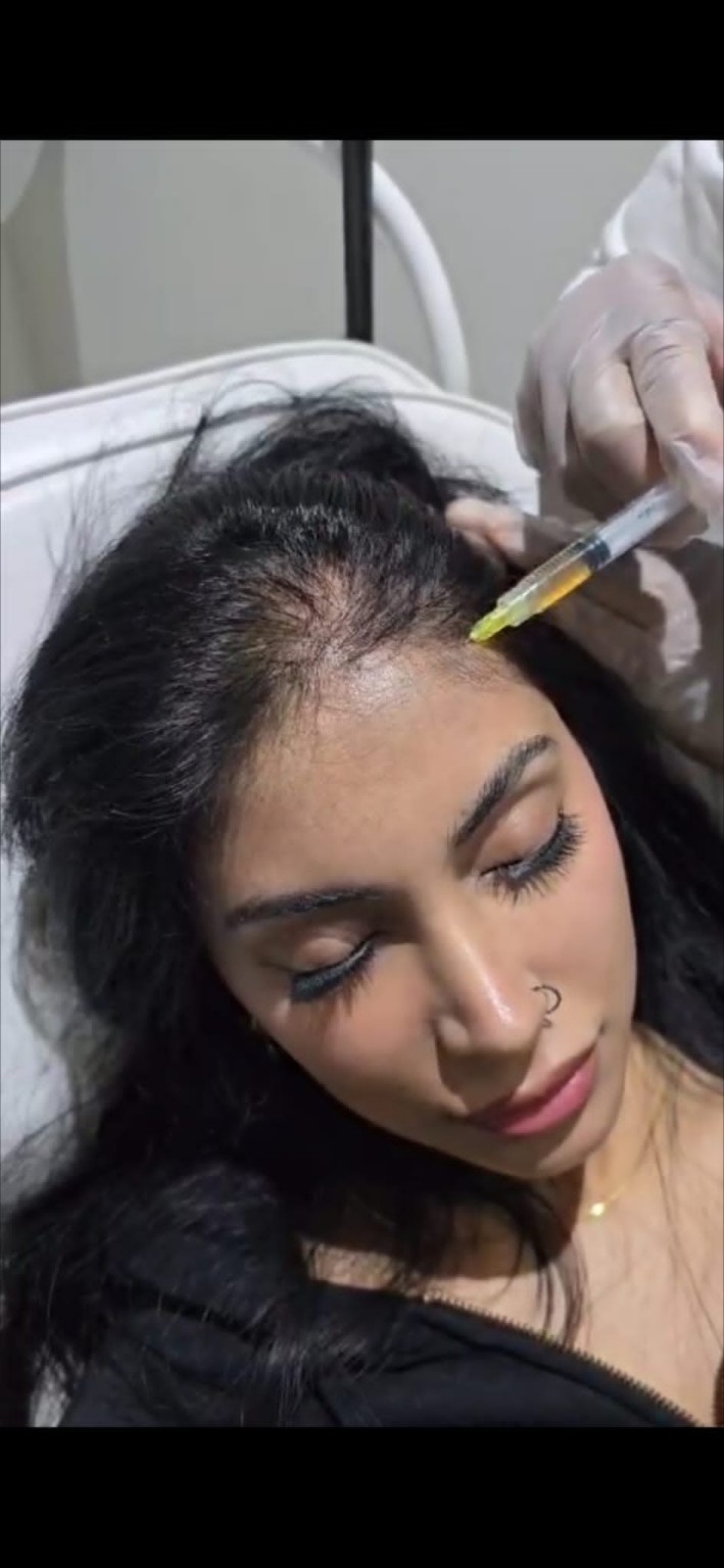 Hair restoration treatment being performed