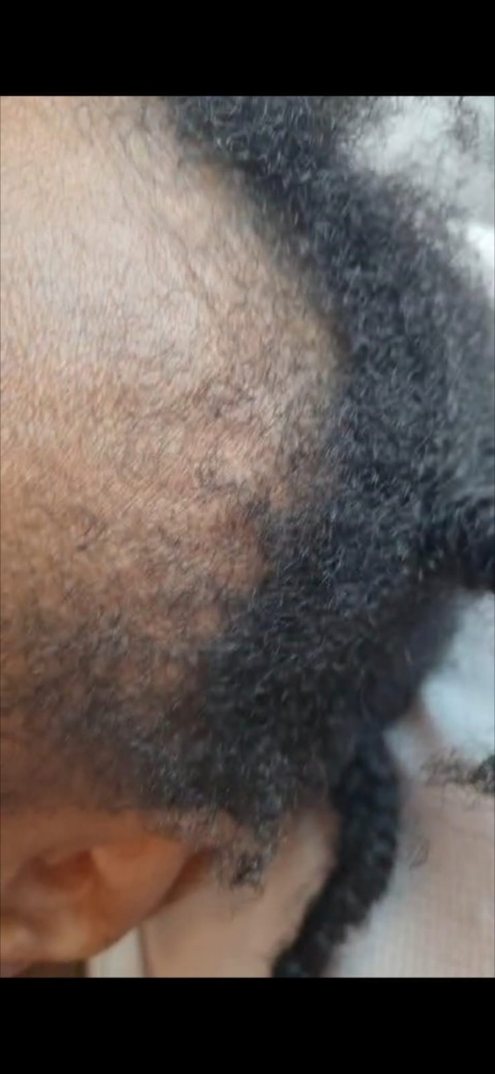 Hair restoration treatment result close-up