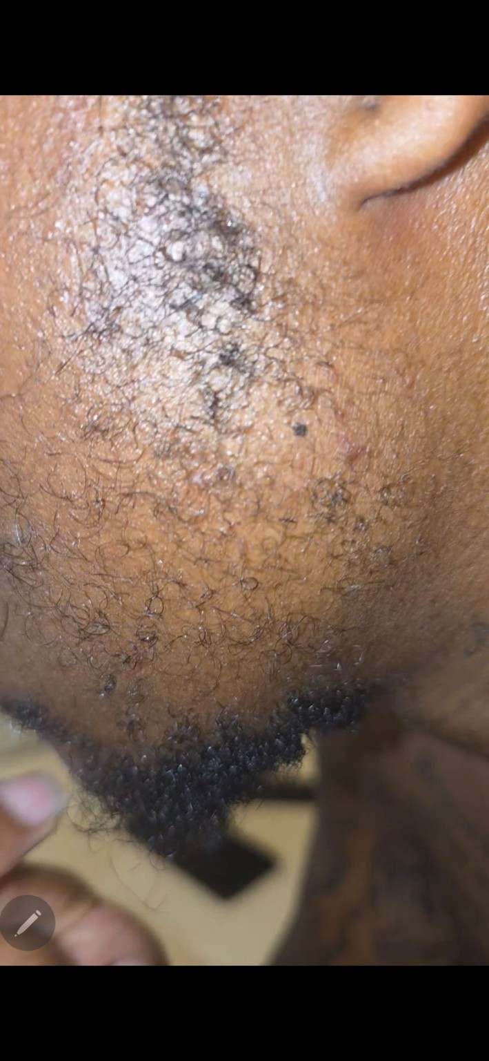 Facial hair treatment close-up image