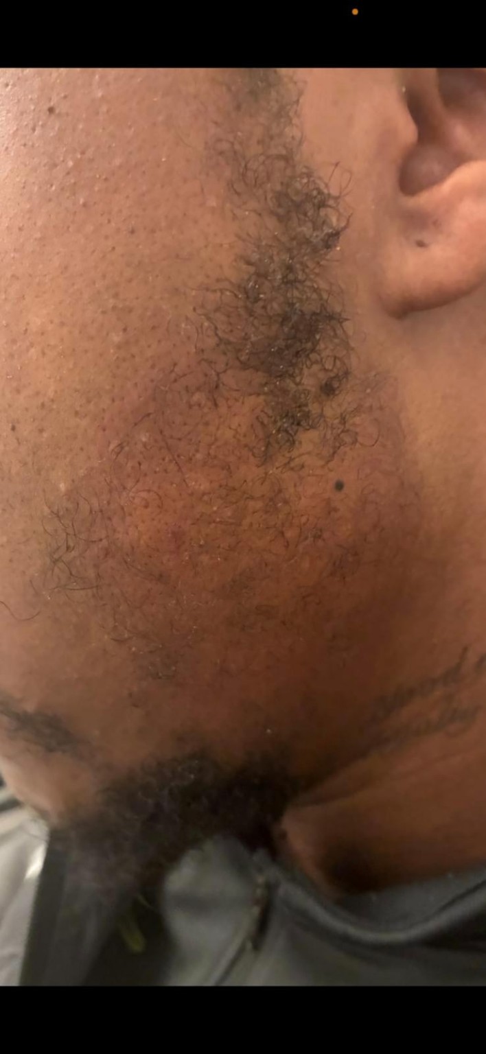 Facial hair treatment progress image