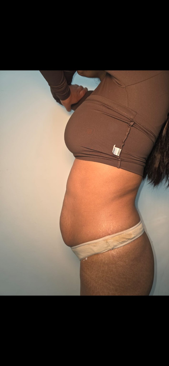 Body contouring side profile image