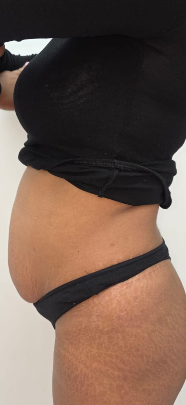 Body contouring progress image