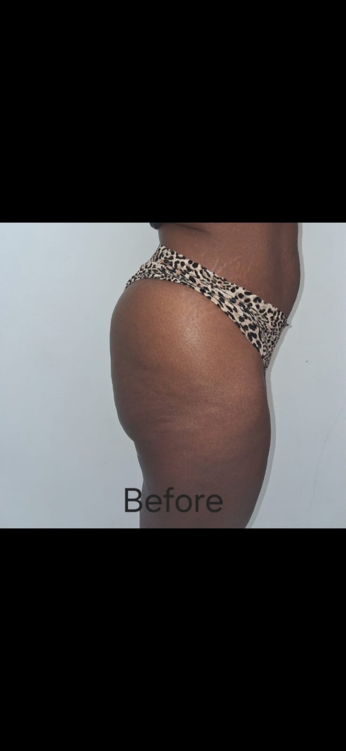 Body contouring before image