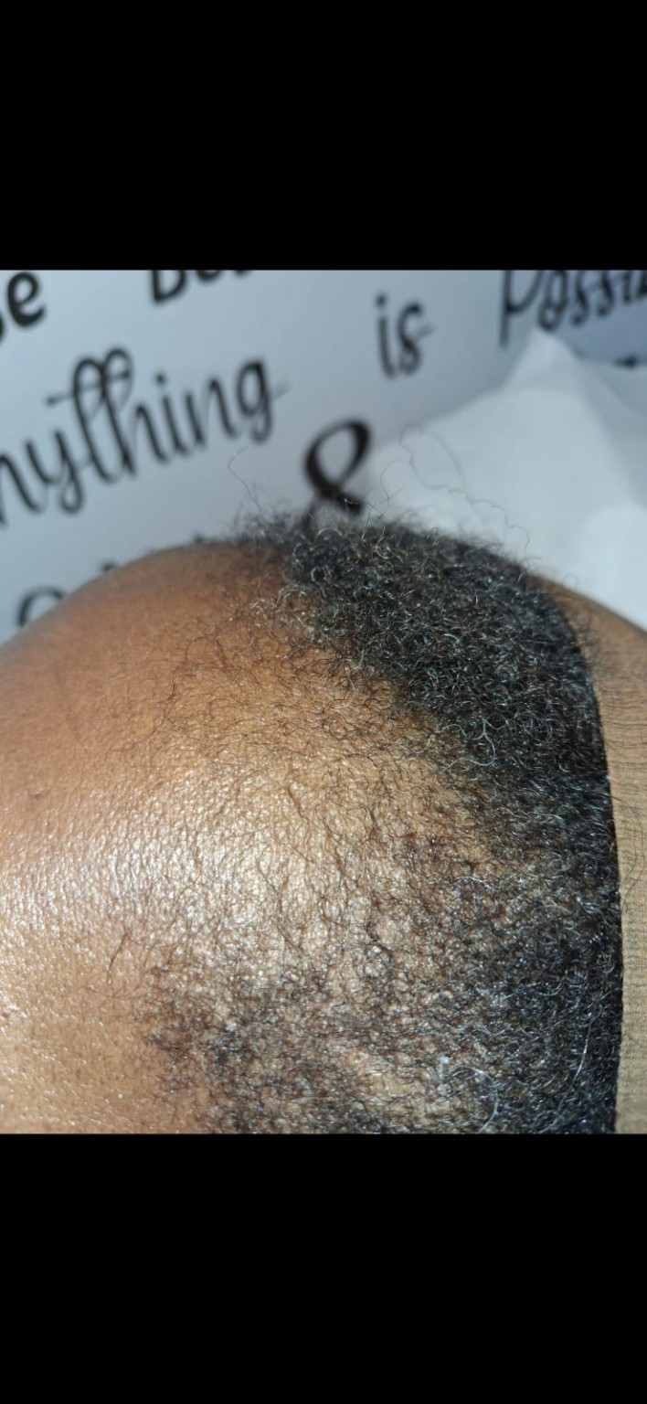 Hair restoration crown progress image