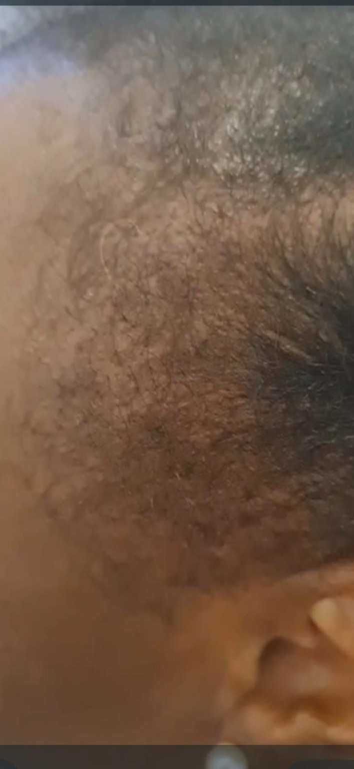 Hair restoration scalp close-up image