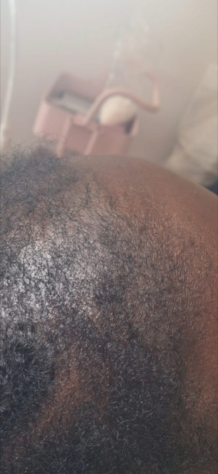 Hair restoration scalp progress image