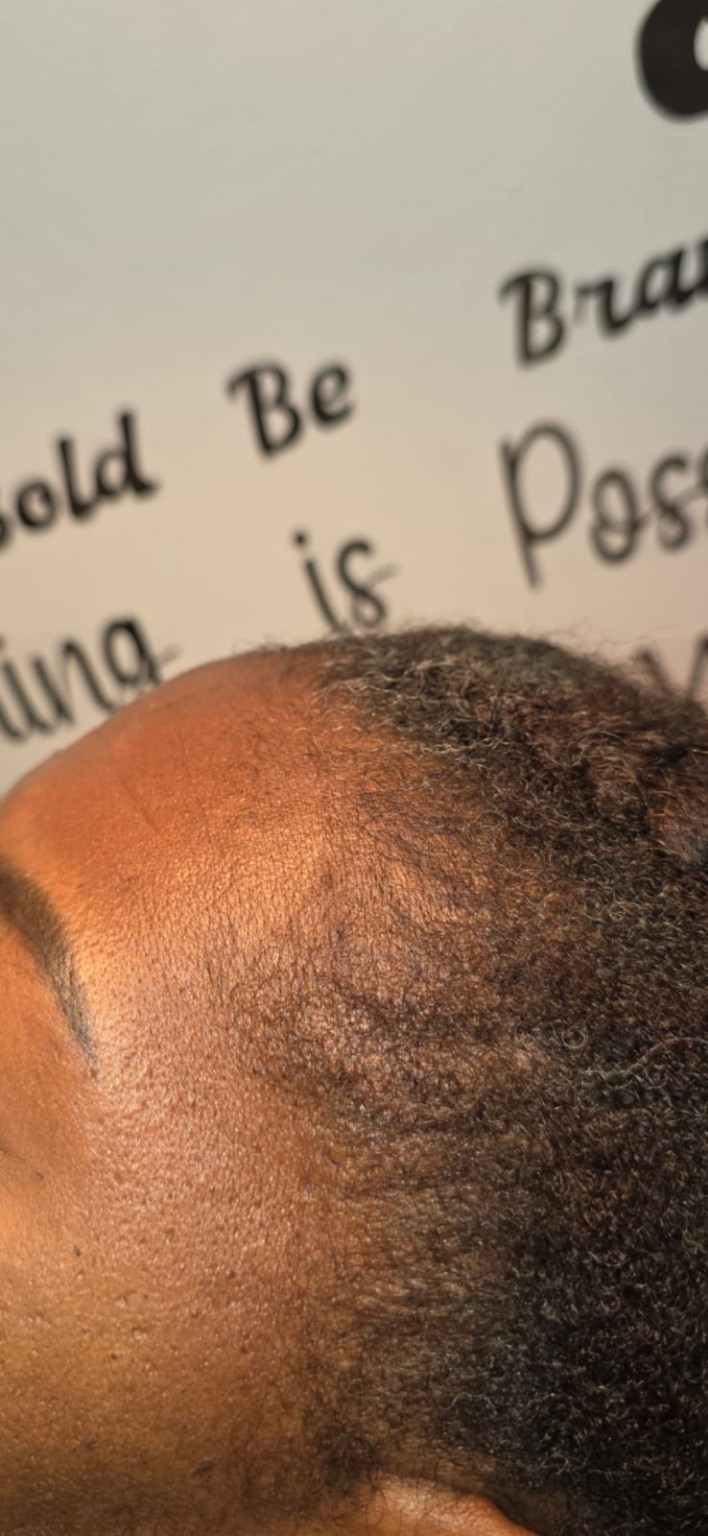 Hairline treatment progress image